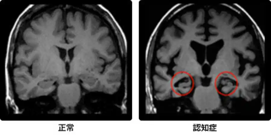 放射線科_MRI_脳