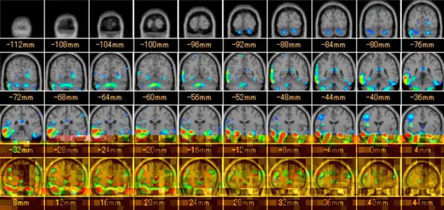 放射線科_MRI_脳２